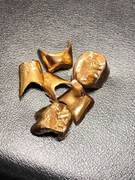 金歯